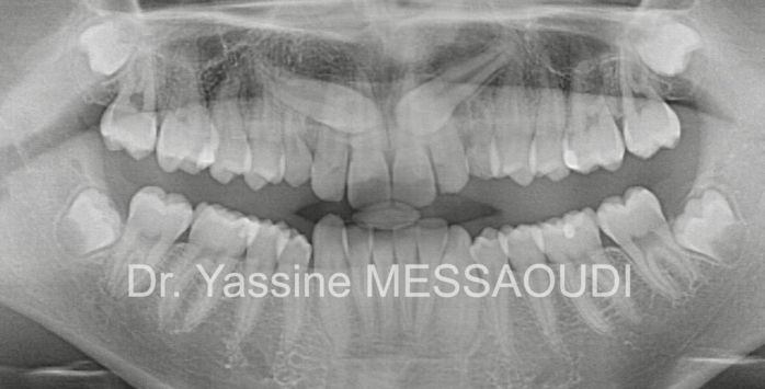 Canine incluse - Avant traitement